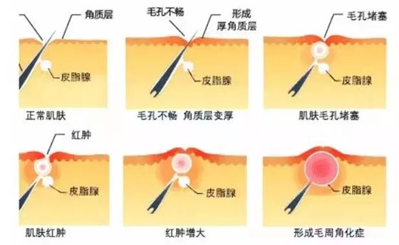 为什么人有时候会起鸡皮疙瘩