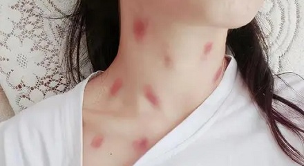 为什么女生的脖子上经常会有红印