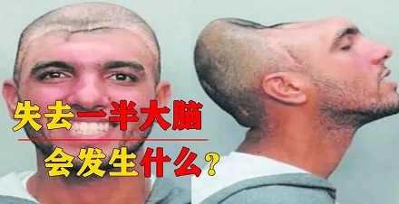 如果我们的大脑少了一半会发生什么后果？