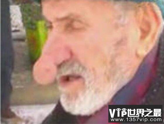 世界上最大的鼻子：土耳其老人鼻子长14厘米