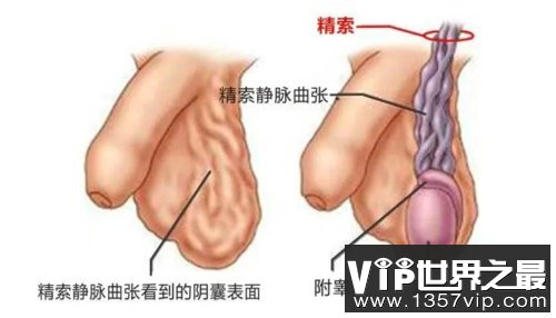 精索静脉曲张