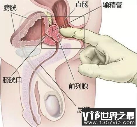 前列腺位置