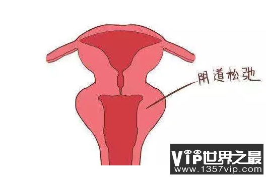 女人阴道松弛怎么办？教你两个方法！