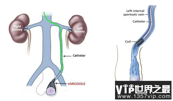 精索静脉曲张是什么